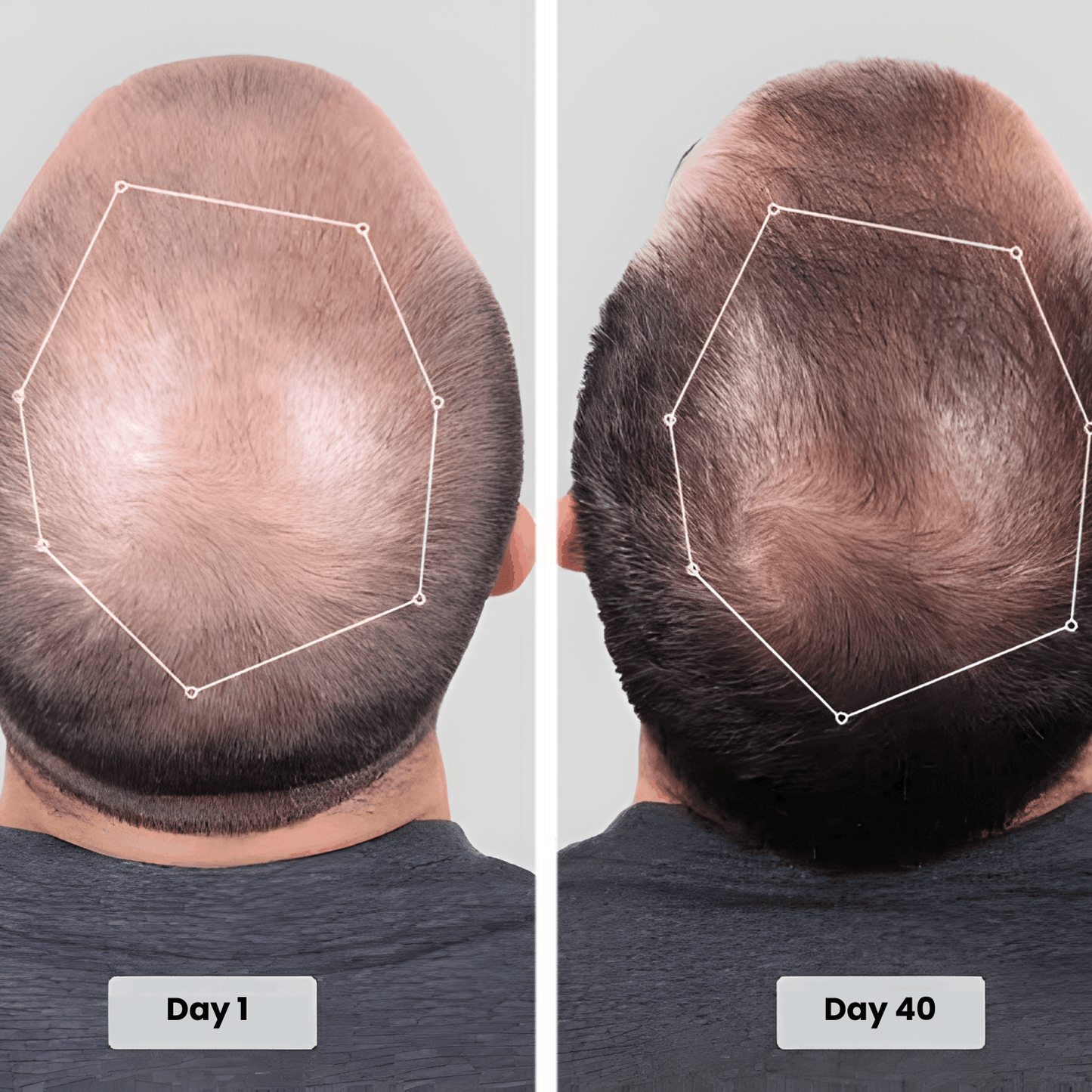 Red Light Therapy Cap for Hair Regrowth Treatments - RevitaCap