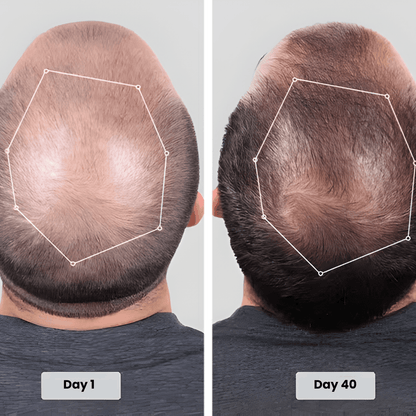 Red Light Therapy Cap for Hair Regrowth Treatments - RevitaCap