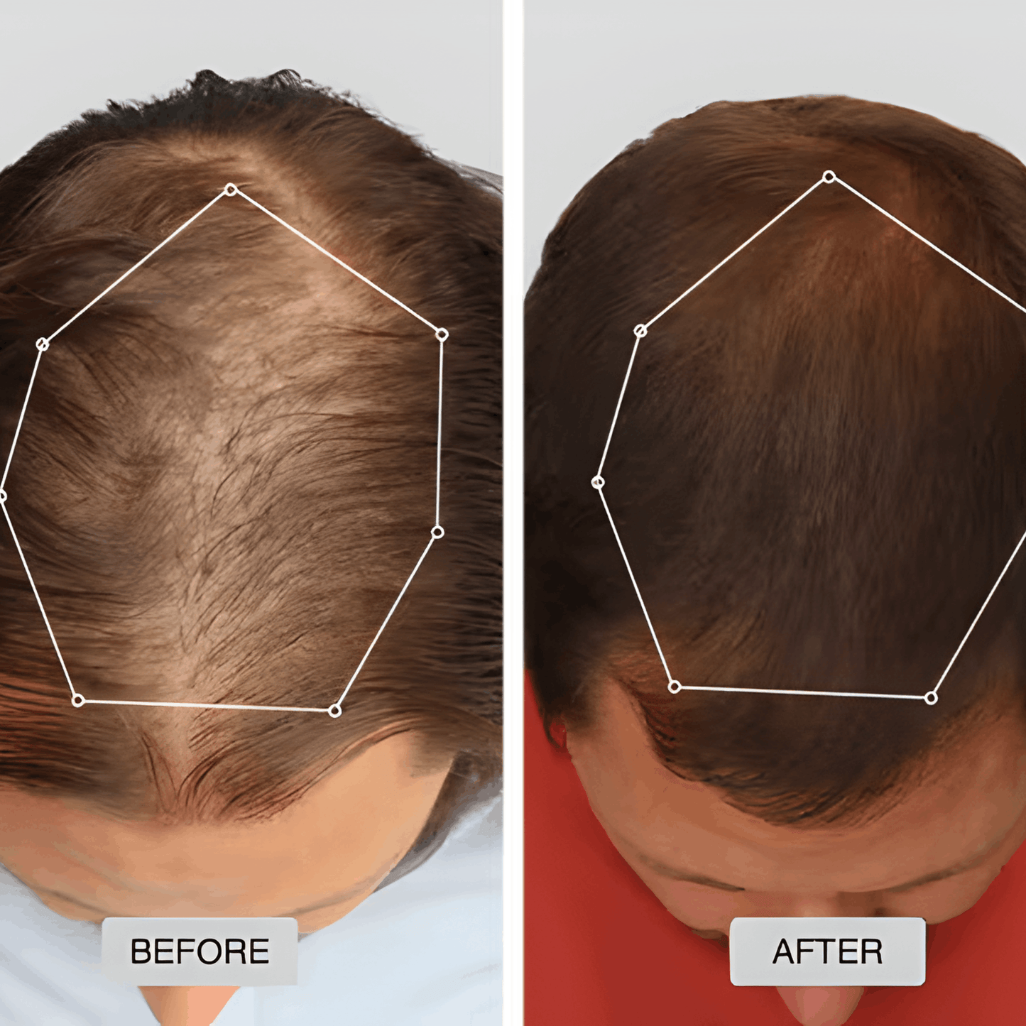 Red Light Therapy Cap for Hair Regrowth Treatments - RevitaCap