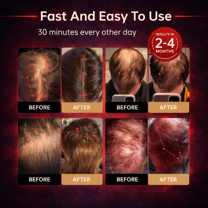 Red Light Therapy Cap for Hair Regrowth Treatments - RevitaCap